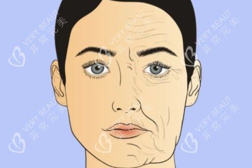 面部衰老提升卡通对比图