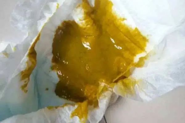 肠易激综合征大便黄黏液图