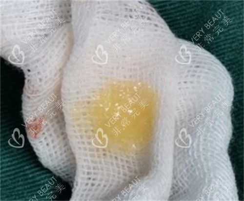 生长因子刚刚注射后取出的样子