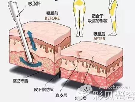 吸脂适应部位及术后效果示意图