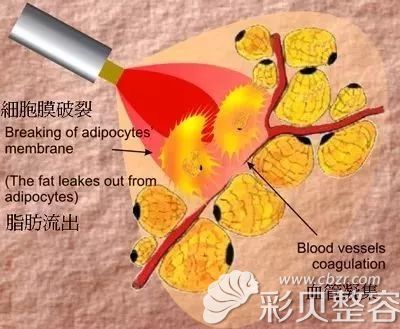 激光溶脂原理图介绍