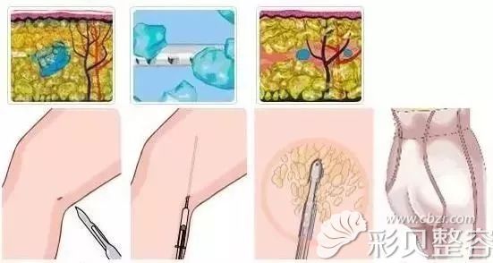 共振吸脂作用原理图