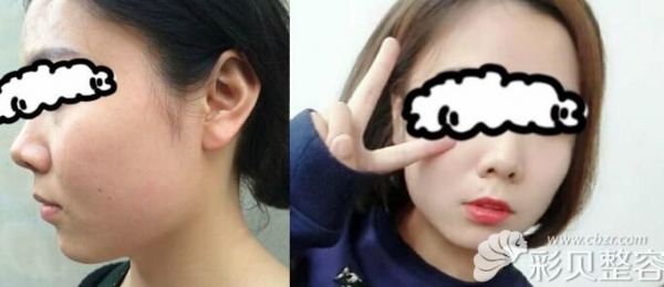 激光溶脂瘦脸三个月效果分享