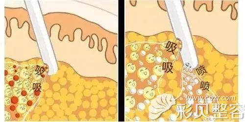 水动力吸脂原理介绍