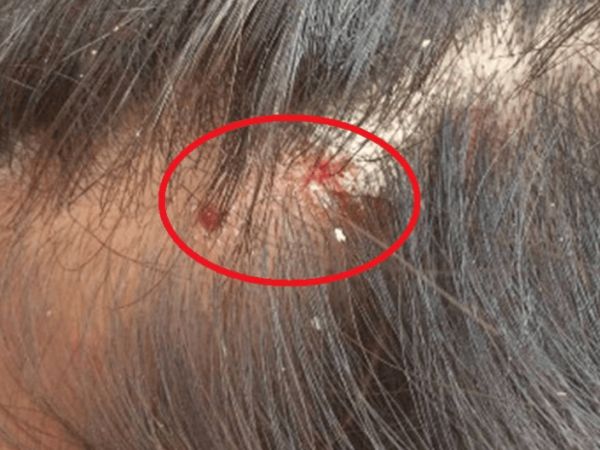 血站hiv核酸混合检测