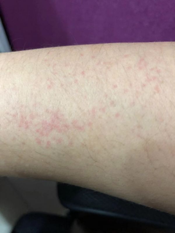 血液中心检测hiv核酸准确吗