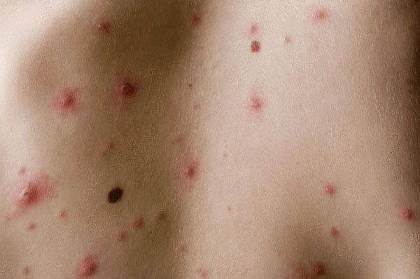 hiv核酸检测的敏感性好大夫