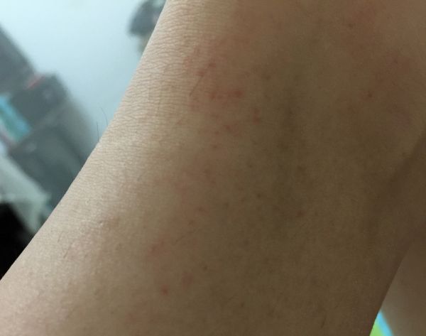 hiv核酸检测实际病例
