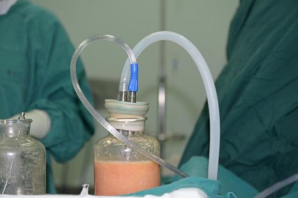 华美吸脂减肥法：科技带来的美丽变革(2)