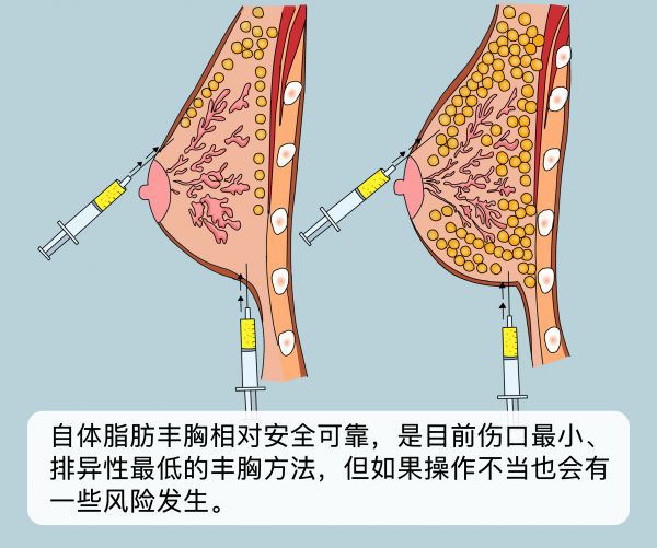 自体脂肪丰胸安全可靠吗.png