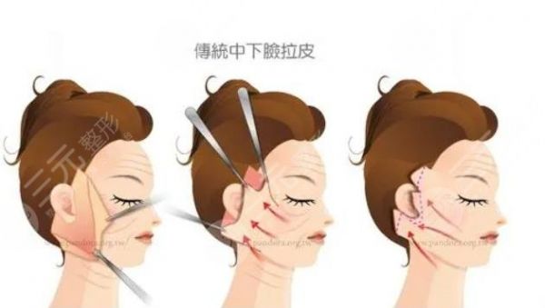 小拉皮手術(shù)操作