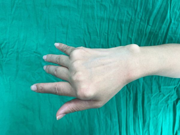 杜姓妇人在手术前右手关节变形、脱位，无法正常开合等动作。（图／陈思恒医师提供）