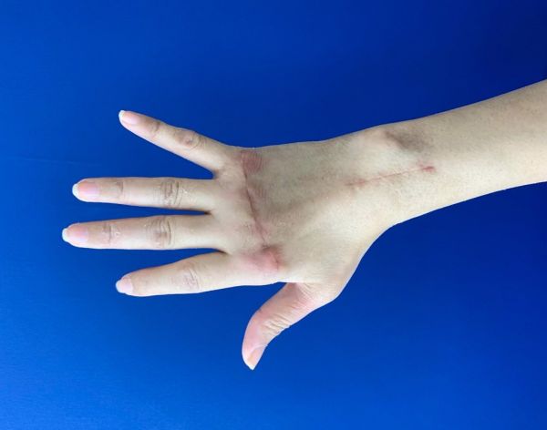 杜姓妇人经由手术置换硅胶关节与修补受损组织，加上3个月的復健，右手手指可正常伸展。（图／陈思恒医师提供）