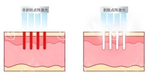 不同类型的点阵激光