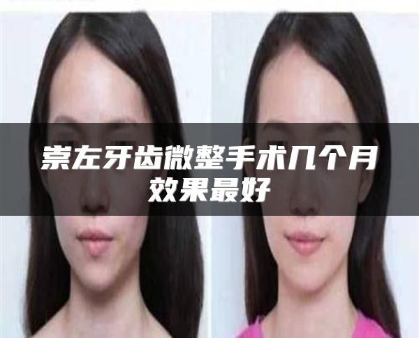 崇左牙齿微整手术几个月效果最好