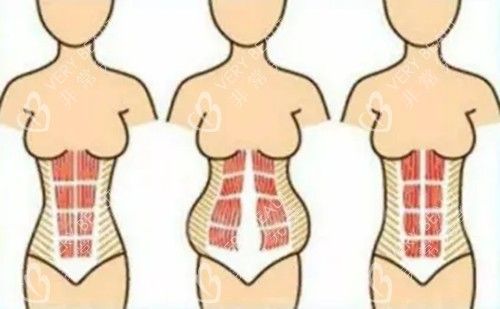 腹壁成形手术卡通示意图