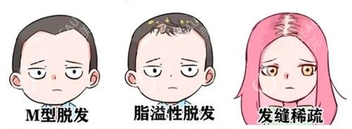 脫發(fā)種類