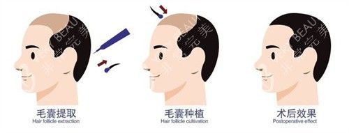 毛囊移植術(shù)前術(shù)后成效動畫圖