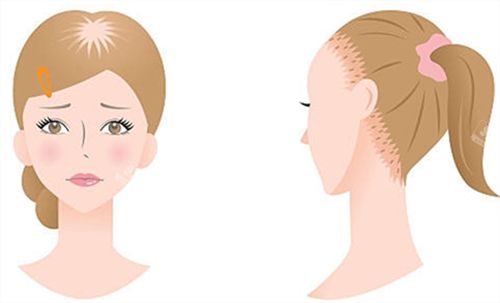 女生脱发类型