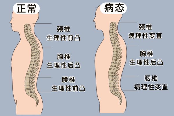 腰椎曲度图
