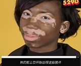 黑人得了白癜风会怎么办?