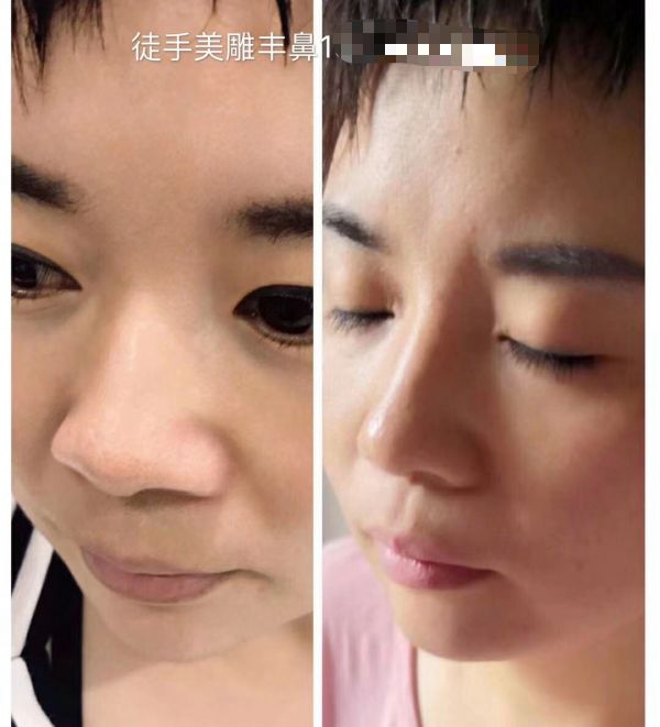 巢湖市王瑞雪针灸美雕学习选择天健针灸美雕包教包会