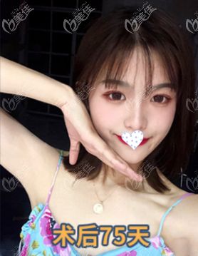 5G黃金微雕下頜緣吸脂75天效果圖