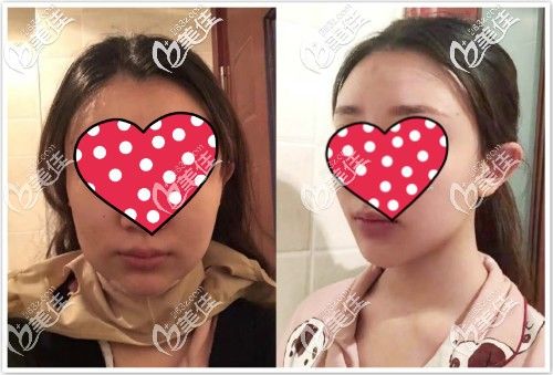 面部黃金微雕親身經(jīng)歷后三個(gè)月效果圖分享