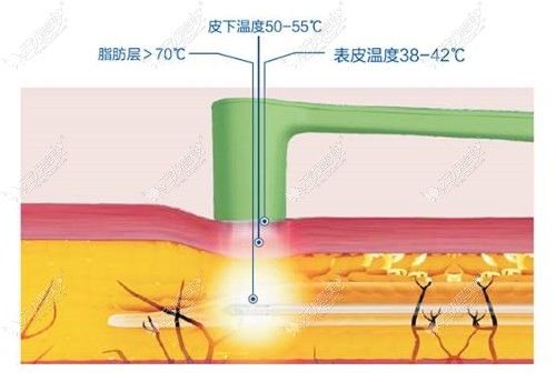 黃金微雕吸脂過程
