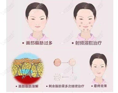 黃金微雕射頻溶脂過程