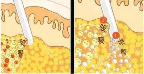 什么叫超聲吸脂術(shù)？