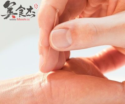 提醒：針灸減肥謹(jǐn)防五大誤區(qū)