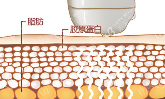 激光溶脂圖