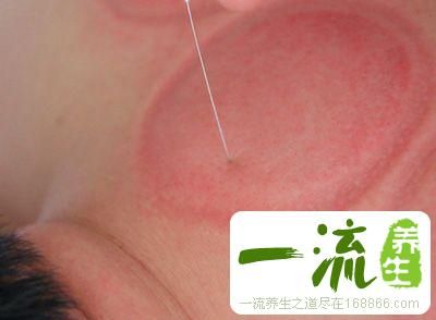 中醫(yī)埋線減肥 中醫(yī)減肥有絕招