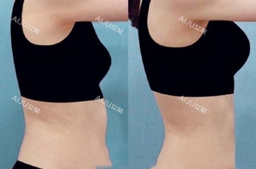 腰腹部吸脂手术前后对比图