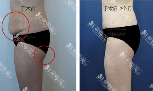 减重手术后的赘皮手术有吗