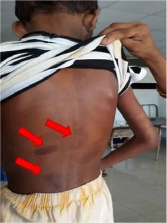 【病案】一個關于患Alagille綜合征10歲男孩的故事（圖1）.jpg
