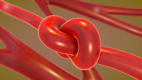 如何治疗动脉硬化