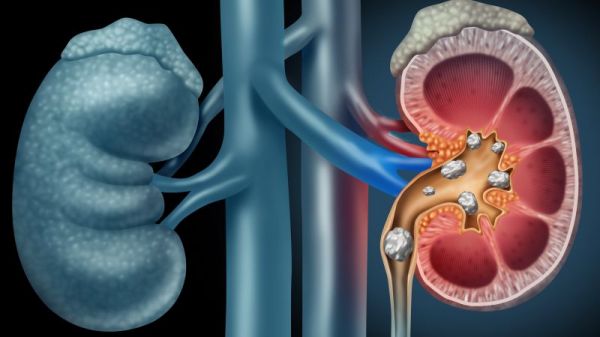肾动脉硬化的饮食
