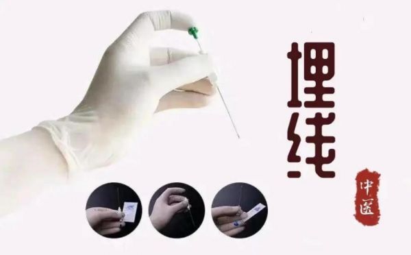 穴位埋線減重——助您輕松享“瘦”