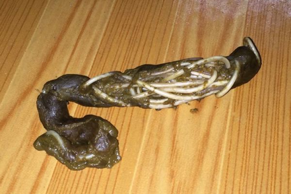 儿童大便蛔虫图