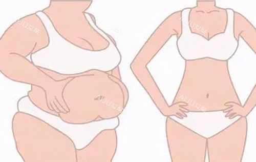 德國Body-jet水動力全身吸脂前后對比示意圖