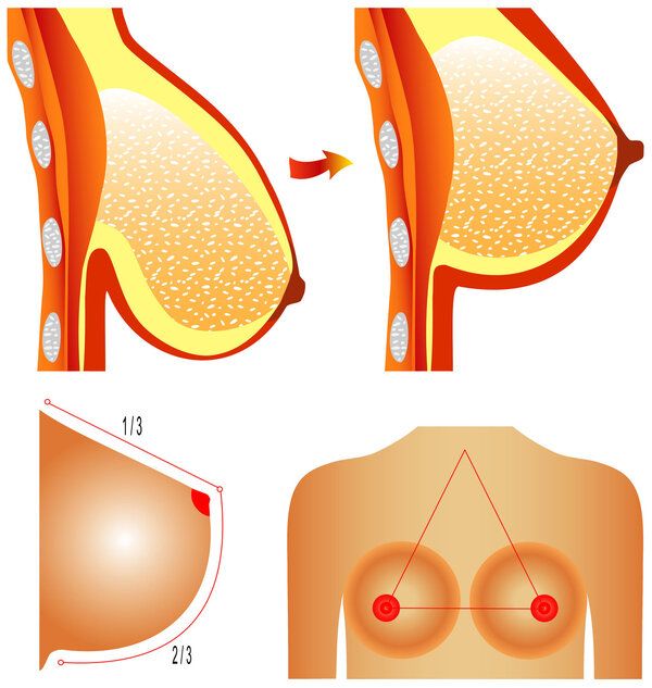 乳房萎縮下垂怎么辦,乳房萎縮下垂要怎么辦