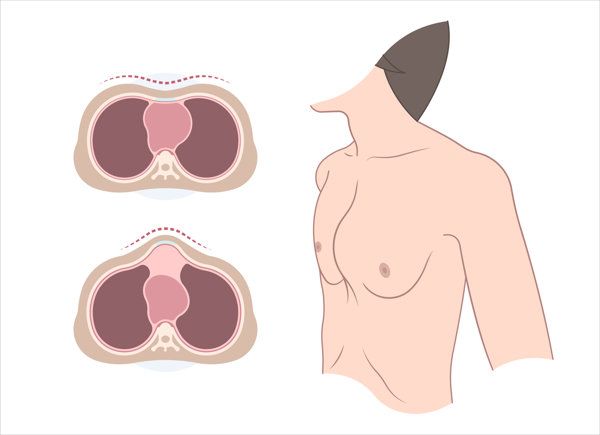 男人隆胸后需要穿女装吗