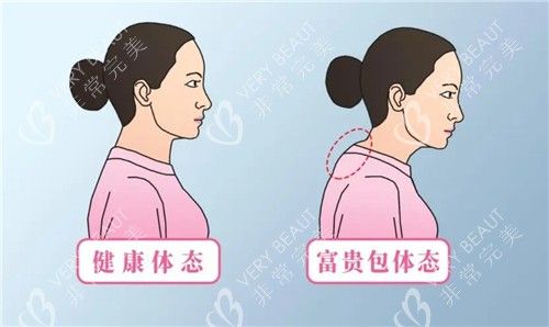 曹孟君富貴包吸脂對比
