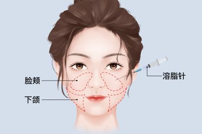 臉部溶脂針位置圖