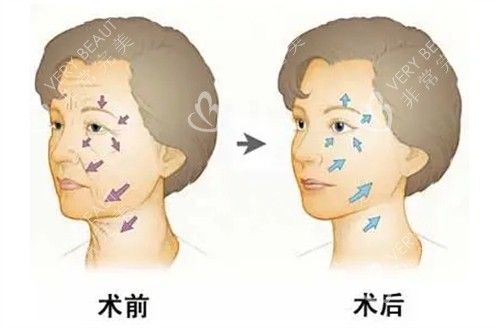 面部年輕化管理前后對(duì)比