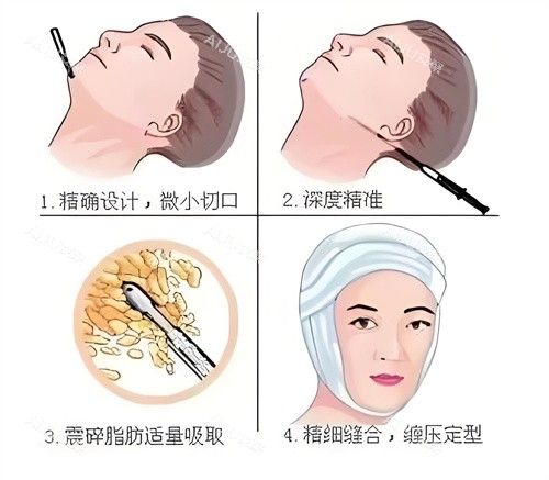 面部吸脂手術(shù)過程演示動(dòng)畫圖