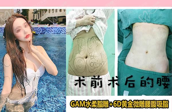 國(guó)內(nèi)吸脂成功機(jī)率高、技術(shù)成熟的減肥抽脂、脂肪豐胸好的醫(yī)院前十