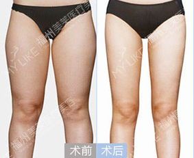全身抽脂大概需要多少錢(qián)？？？